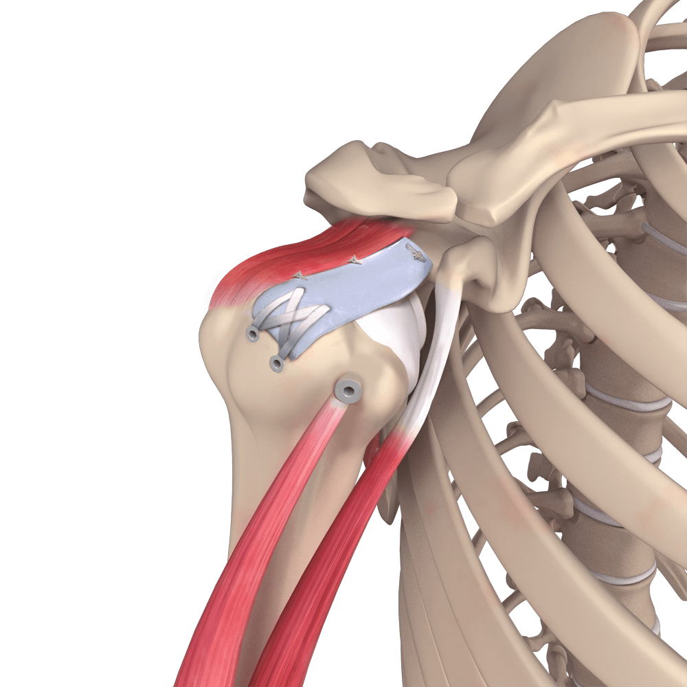 shoulder superior capsular reconstruction